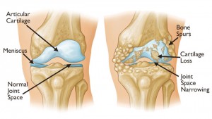 Knee_Osteoarthritis