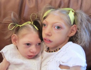 microcephaly-children-born-with-microcephaly